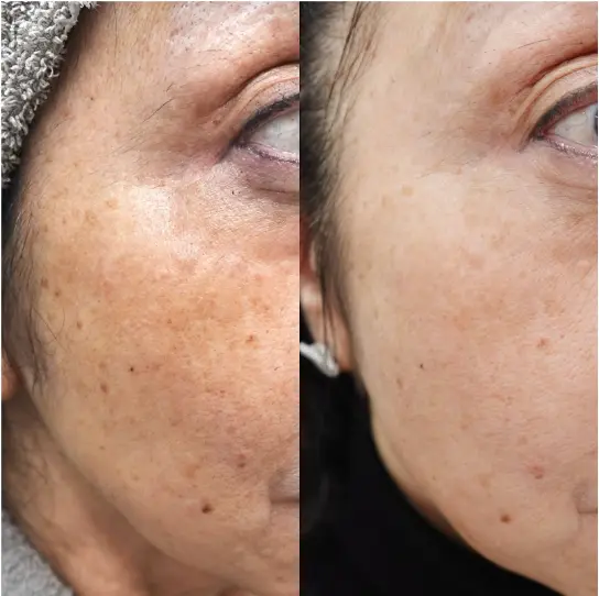 顔広範囲の肝斑含む色素沈着の症例2